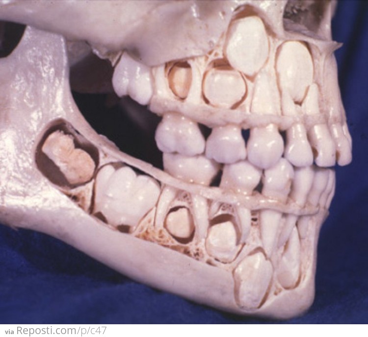 Child's Skull Before Losing Baby Teeth