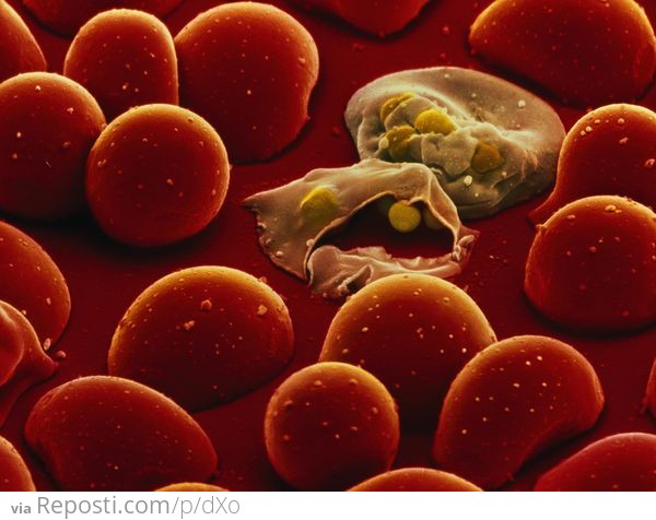 Red blood cells infected with malaria