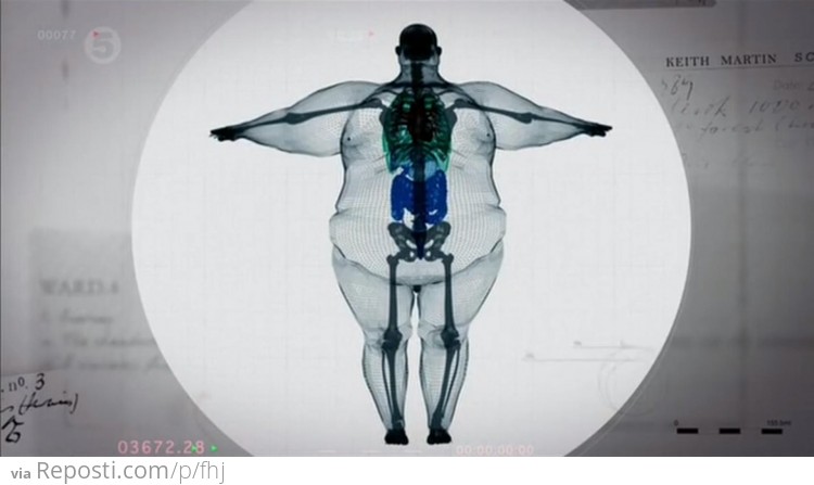 X-ray of a 900 pound man