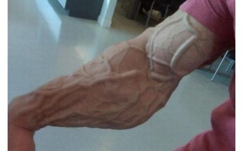 Iiiv'e got veins