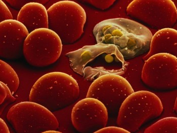 Red blood cells infected with malaria