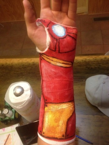 Dealing with a broken wrist