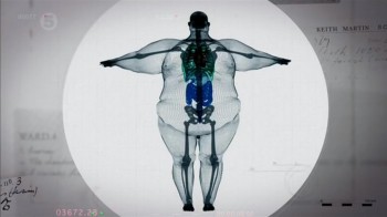 X-ray of a 900 pound man